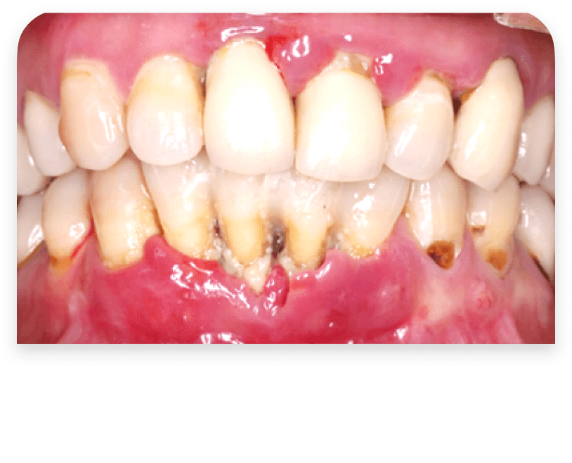 Techniques Parodontales - Before